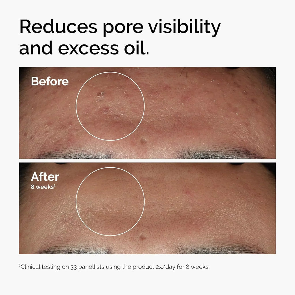 10% Niacinamide 1% Zinc Face Serum 30ml, Oil Control Pore Minimizer, Anti-Acne Dark Spot, Gentle Skin Care for All Skin Types Oasis Select