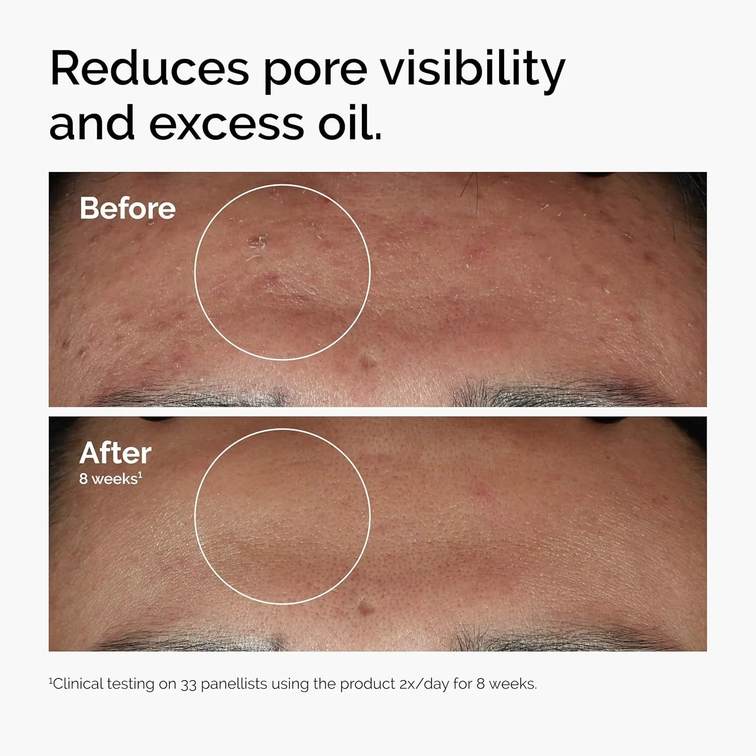 10% Niacinamide 1% Zinc Face Serum 30ml, Oil Control Pore Minimizer, Anti-Acne Dark Spot, Gentle Skin Care for All Skin Types Oasis Select