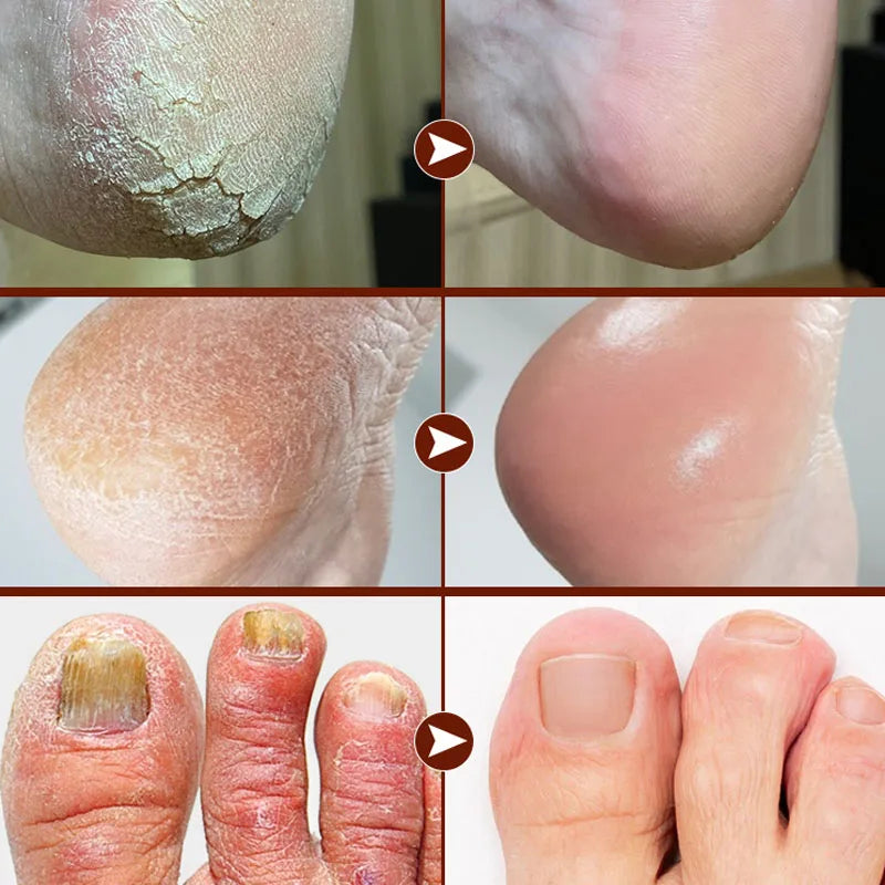 60% Urea Foot Cream with Aloe Vera – Deep Hydration 40g