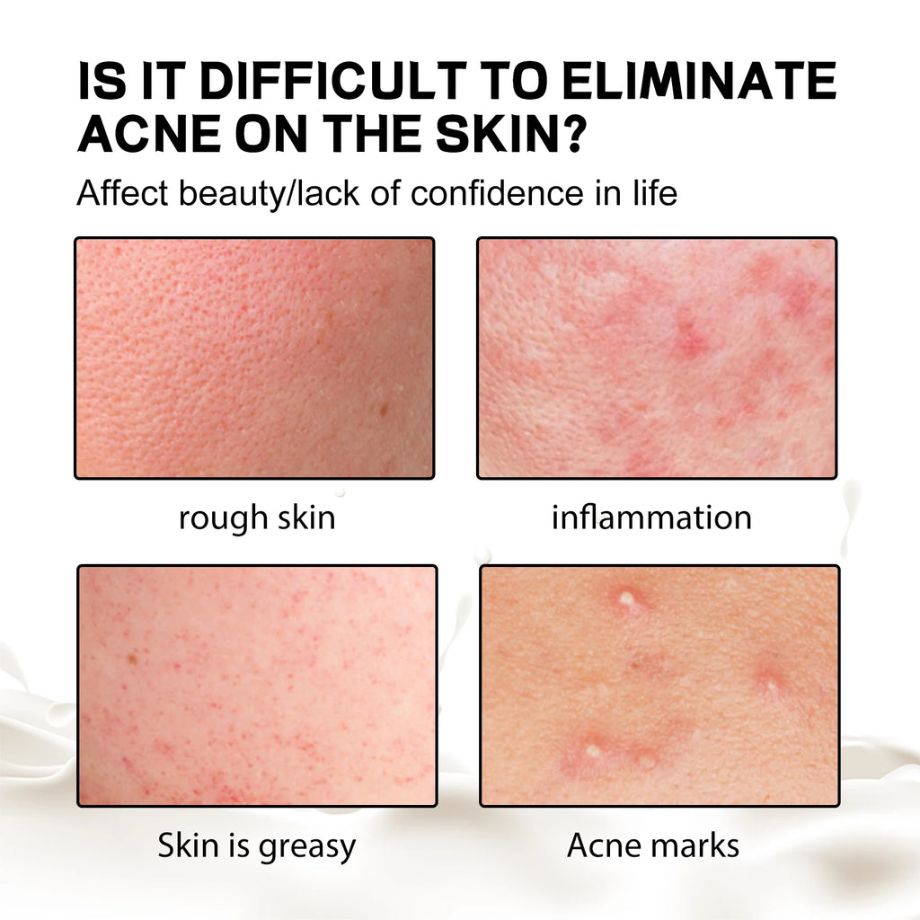 Jaysuing Back Acne Soap – Deep Cleanse, Exfoliate & Fade Spots Acne Treatment Soap Oasis Select
