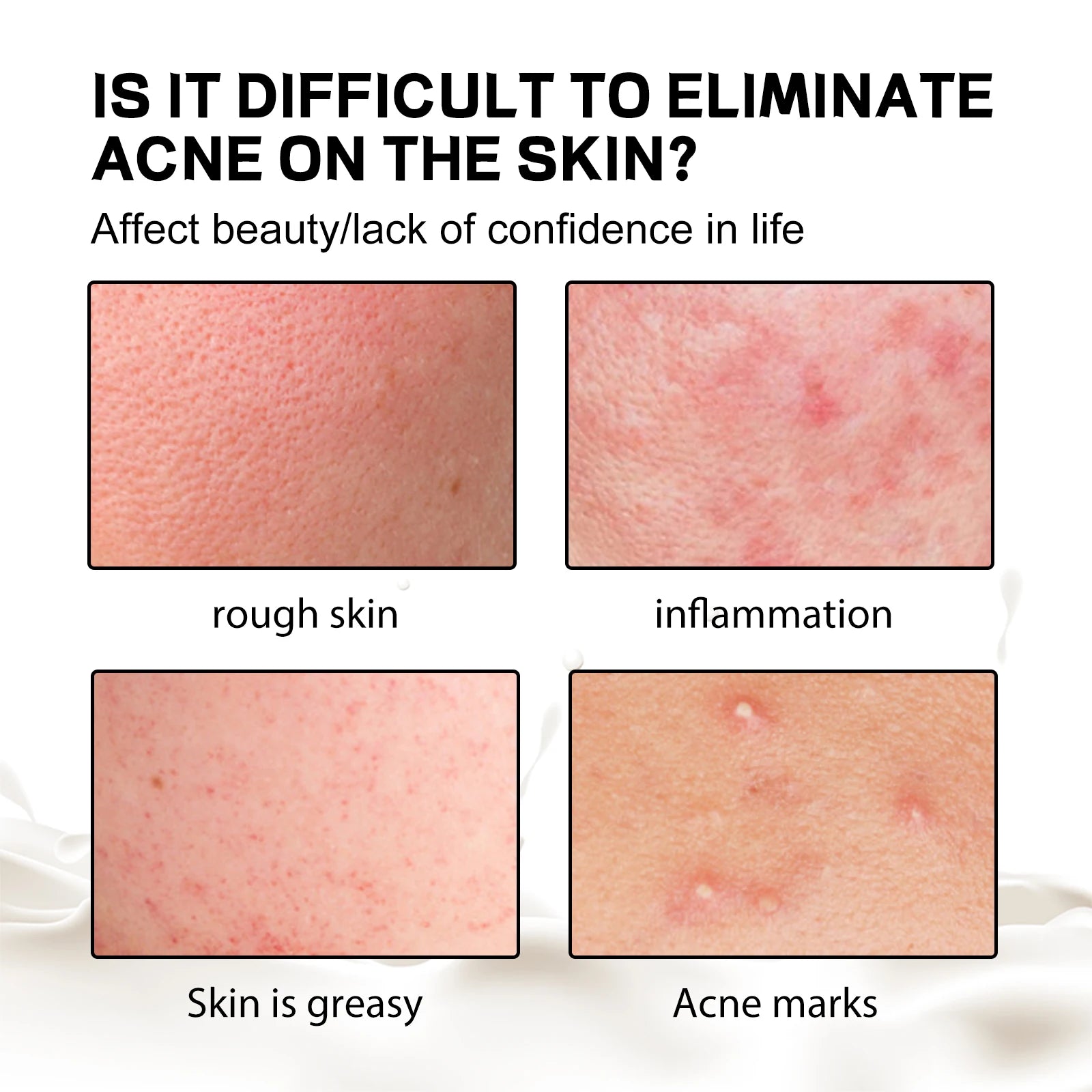 Jaysuing Back Acne Soap – Deep Cleanse, Exfoliate & Fade Spots Acne Treatment Soap Oasis Select
