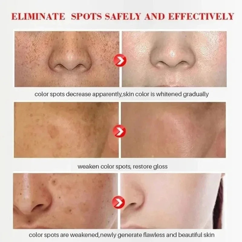 Whitening Freckle Cream Remove Dark Spots Anti Freckle Face Creams Niacinamide Fade Pigmentation Melasma Brighten Skin Care 20g Oasis Select