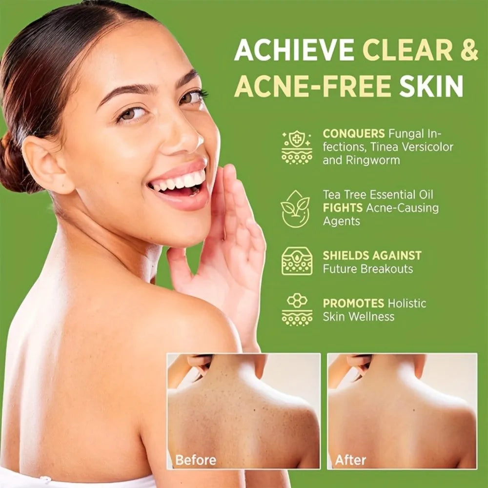 MIAOFUTONG Gentle for Sensitive Skin TEA TREE OILANTIFUNGAL SOAP Plant-Based Care Moisturizing FormulaG lmproving acne Oasis Select