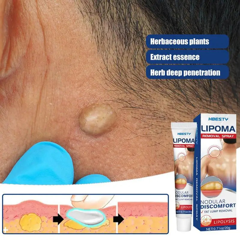 Lipoma Removal Cream Relief Swelling Fat Elimination Cream 20g Remove Subcutaneous Lump Herbal Extract Care Fat Bulges Lump Oasis Select