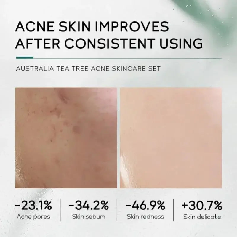Natural Tea Tree Face Care Kit Complete Routine With Cleanser Moisturizer Toner Serum Gel For Oily Skin Oasis Select