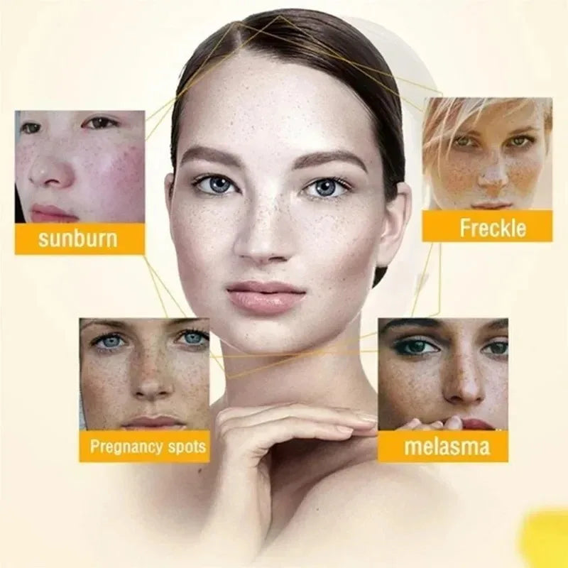 Whitening Freckle Cream Remove Dark Spots Anti Freckle Face Creams Niacinamide Fade Pigmentation Melasma Brighten Skin Care 20g Oasis Select
