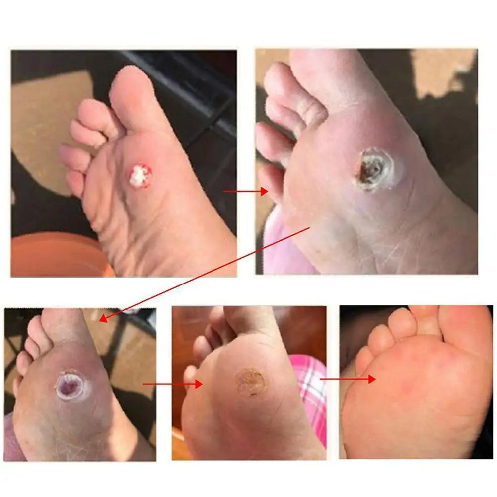 6-Pack Corn & Callus Remover Pads – Self-Stick Foot Patches Foot Corn Remover Oasis Select