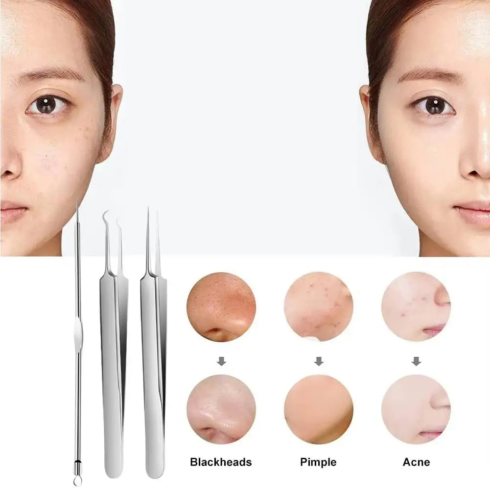 3-Piece Stainless Steel Acne Needle & Blackhead Remover Kit Acne Extraction Tool Oasis Select