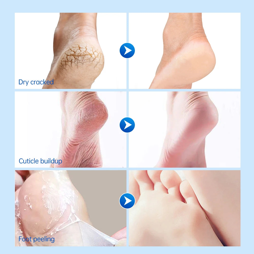 Urea Foot Cream Moisturizing Exfoliating Hand Feet Dead Skin Removal Anti Peeling Heels Repair Mask Foot Skin Care Products Oasis Select