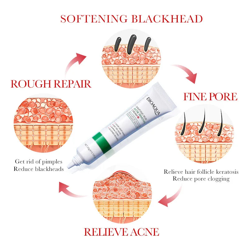 BIOAQUA Salicylic Acid Acne Face Cream – Blackhead & Mark Repair Acne Treatment Cream Oasis Select