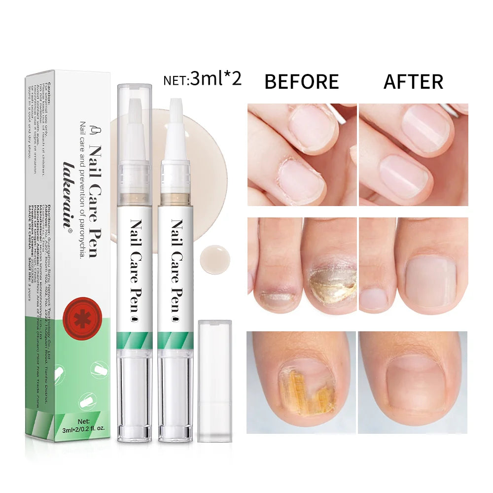 Nail Growth Cuticle Oil Pen – 2-Pack Nail Treatment | ibcccndc Nail Treatment Oil Oasis Select
