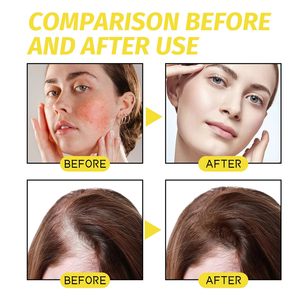 Eelhoe Hair Growth Essential Oil – Thinning & Baldness