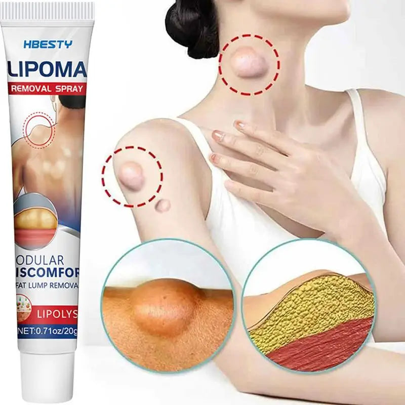 Lipoma Removal Cream Relief Swelling Fat Elimination Cream 20g Remove Subcutaneous Lump Herbal Extract Care Fat Bulges Lump Oasis Select