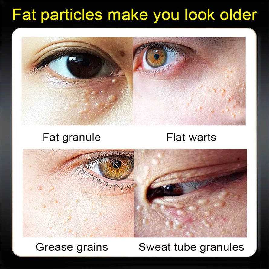 Fat Granules Remover Eye Cream Anti-Puffiness Anti Inflammatory Reduce Dark Circles Eyebags Fade Lines Moisturizing Eye Care Oasis Select