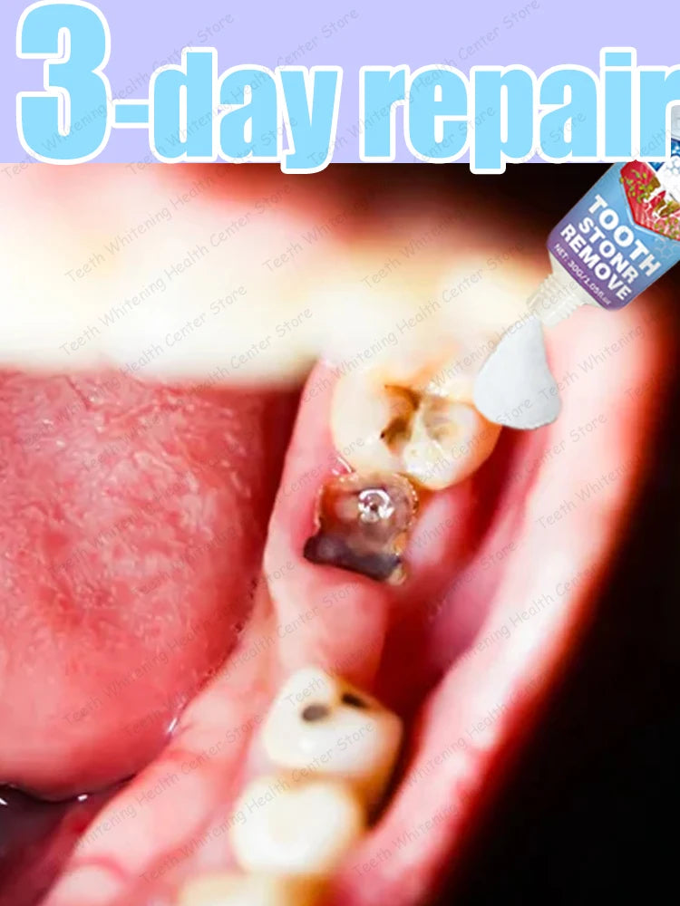 Restorative Dental Cream – Cavity Repair & Teeth Strengthening