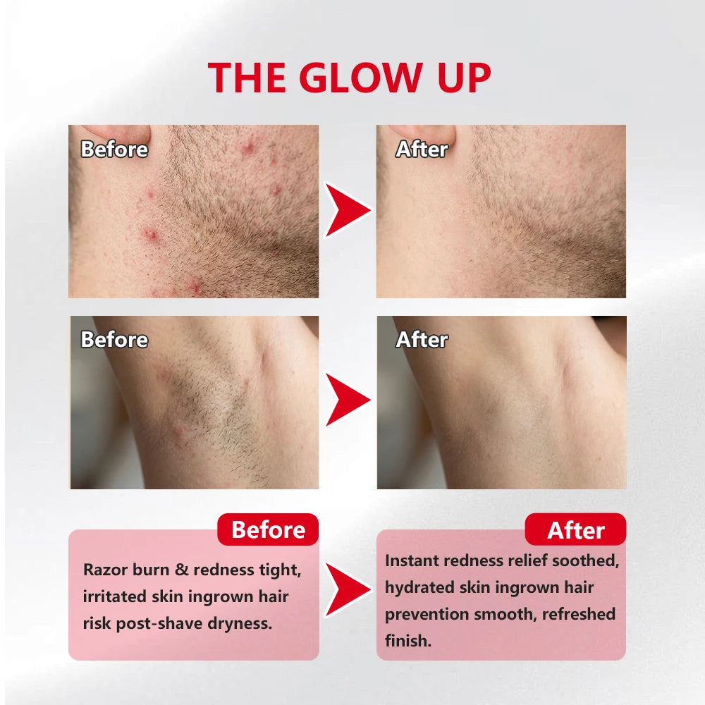 Ingrown Hair Care Pads Aftershave Treatment Powerful Gentle Formula Soothe Skin For Men & Women Underarms Bikini Area Face Neck Oasis Select