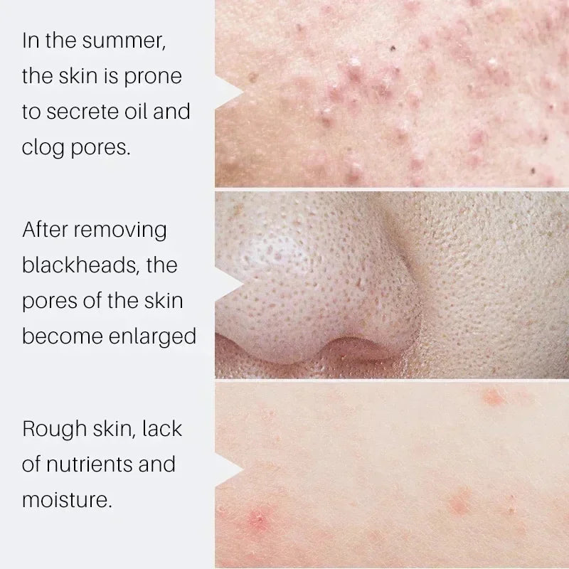 Salicylic Acid Pore Shrinking Serum | Blackhead & Acne Serum Face Serum Oasis Select