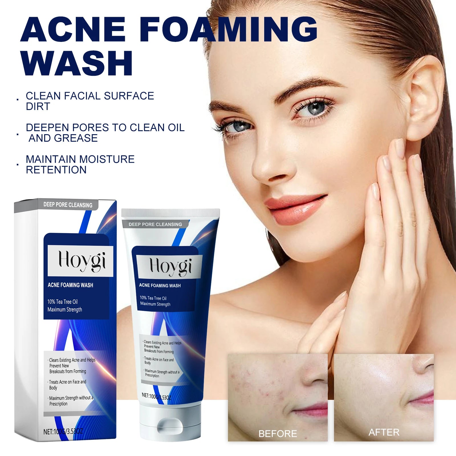 Hoygi Anti-Acne Facial Cleanser – Oil Control & Pore Minimizer
