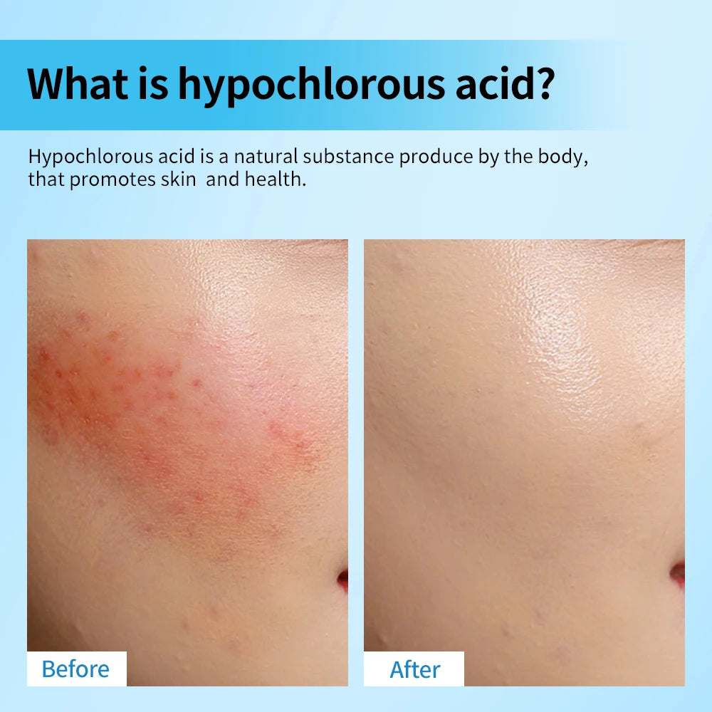 Hypochlorous Acid Facial Spray – Calming Skin Mist 65ml