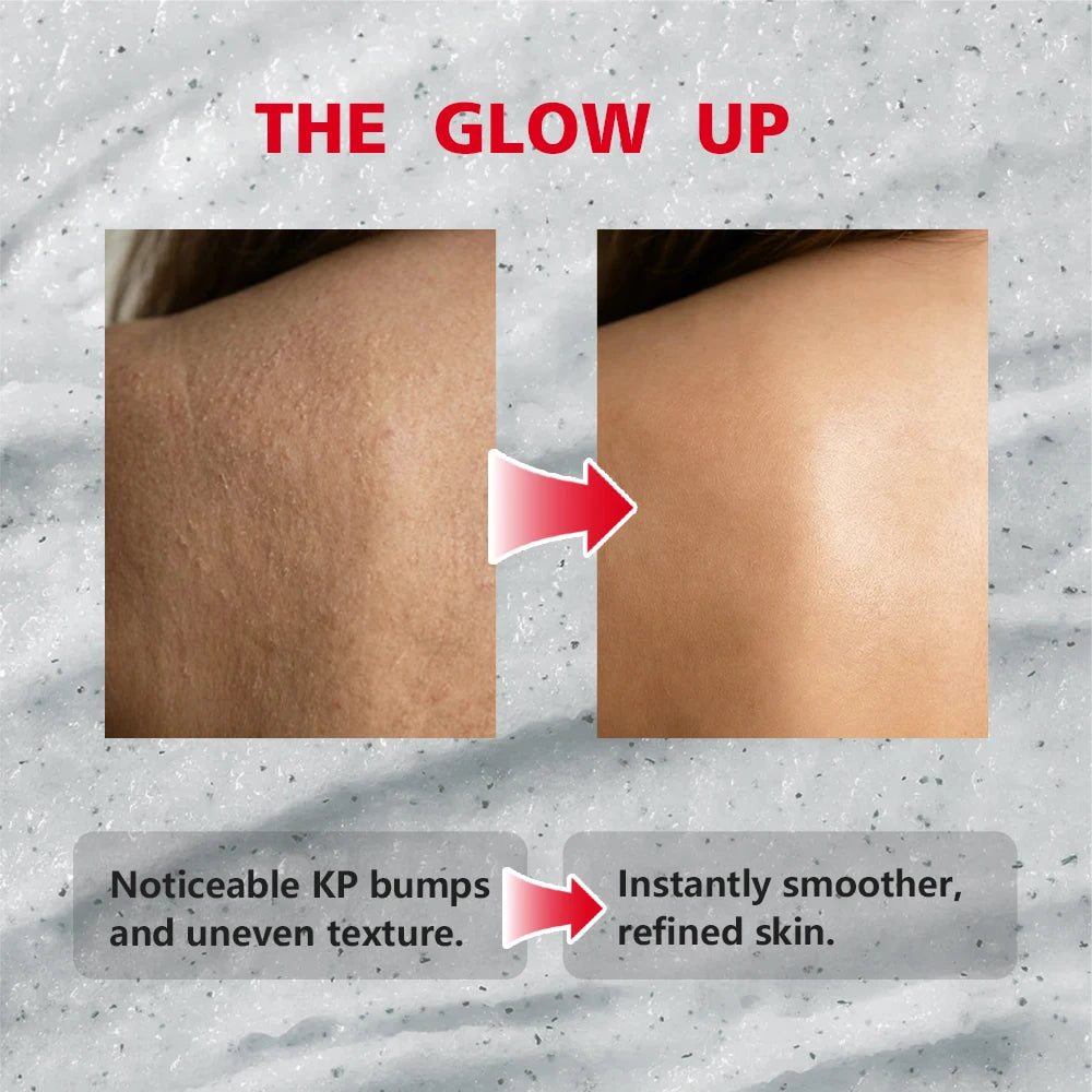 KP Bump Eraser Body Scrub Keratosis Pilaris Skin Exfoliator Helps Reduce Chicken Bumps Exfoliate to Reduce Dullness Skin Care Oasis Select