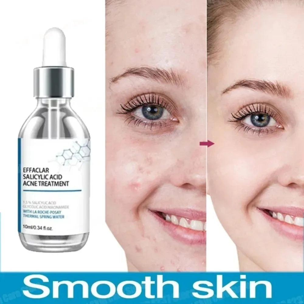 Eelhoe Salicylic Acid Face Serum – Pore Minimizer & Oil Control