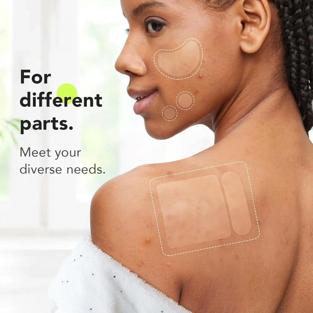 Hydrogel acne removing patch (4 shapes), 180 pieces/box, deep cleaning acne removing patch, effective acne removing patch Oasis Select