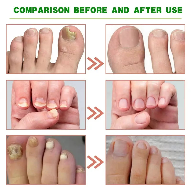 Ginger Nail Repair Serum – Restore Discolored & Uneven Nails Nail Treatment Serum Oasis Select
