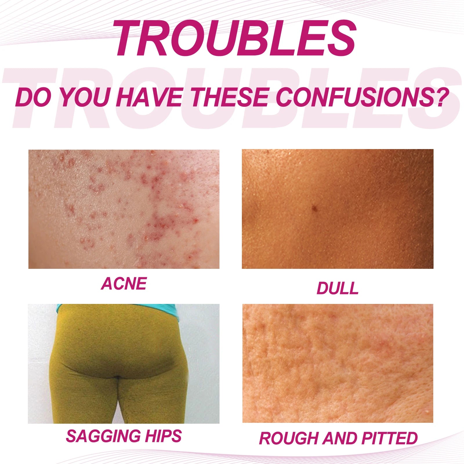 Butt Thigh Acne Cream Remove Pimples Moisturizing Clarifying Brightening Smoothing Skin Care Thigh Acne Removal Cream Oasis Select