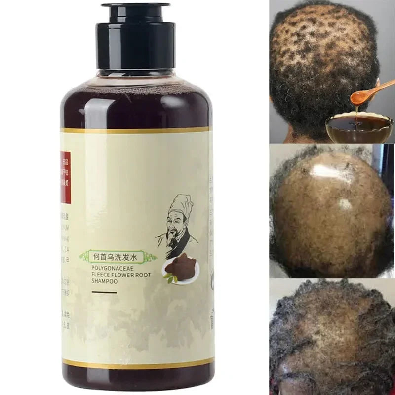 Africa Women Traction Alopecia Treatment Hair Loss Treatment Get Rid of Wigs Hair Growth Product for Men Shampoo 300ml Hair Care Oasis Select