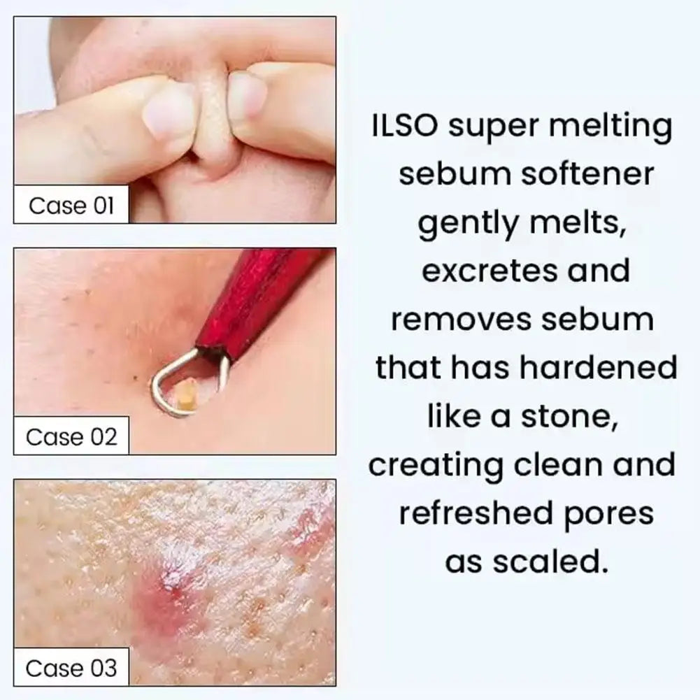 150ML Koorean Blackhead Extractor Toner Super Melting Sebum Softener Stronger Blackhead Cleansing ilso Moisturizing Facial Care Oasis Select