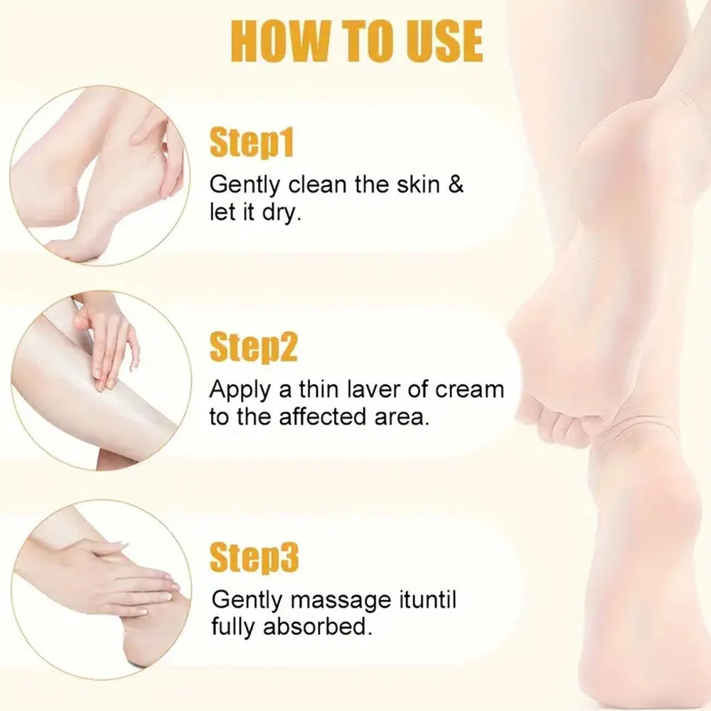 Urea 40% Foot Cream – Dry Cracked Heel & Skin Repair | YOUNGCOME