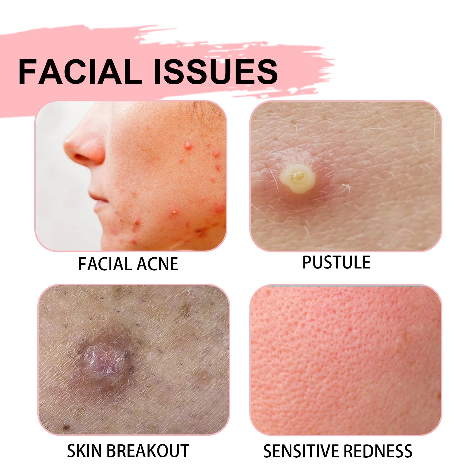 EELHOE Salicylic Acid Acne Lotion – Pores & Blackheads 30ml