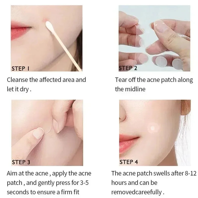 LANBENA Acne Pimple Patch – Invisible Blemish Cover Stickers