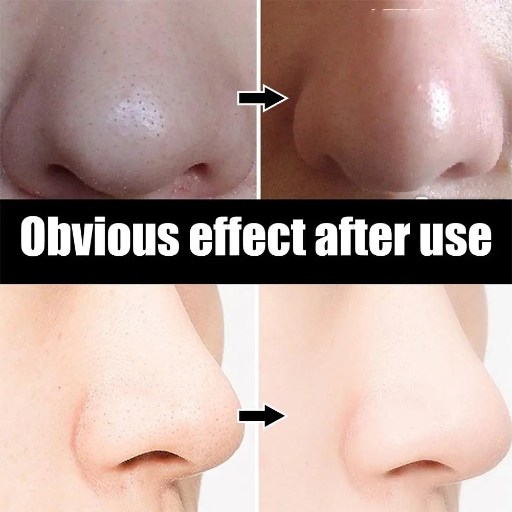 10pcs/Box Blackhead Remover Nose Strips Nasal Patch Deep Cleaning Shrink Pores Acne Treatment Nose Blackhead Mask Strip Skincare Oasis Select