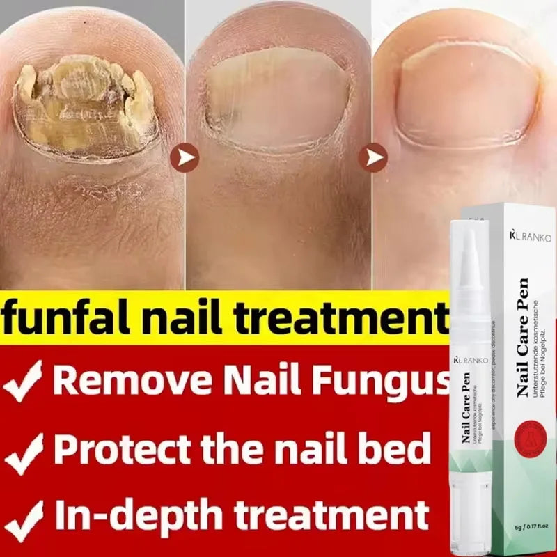 Nail Repair Serum – Foot & Toe Nail Restoration Oil Nail Repair Serum Oasis Select