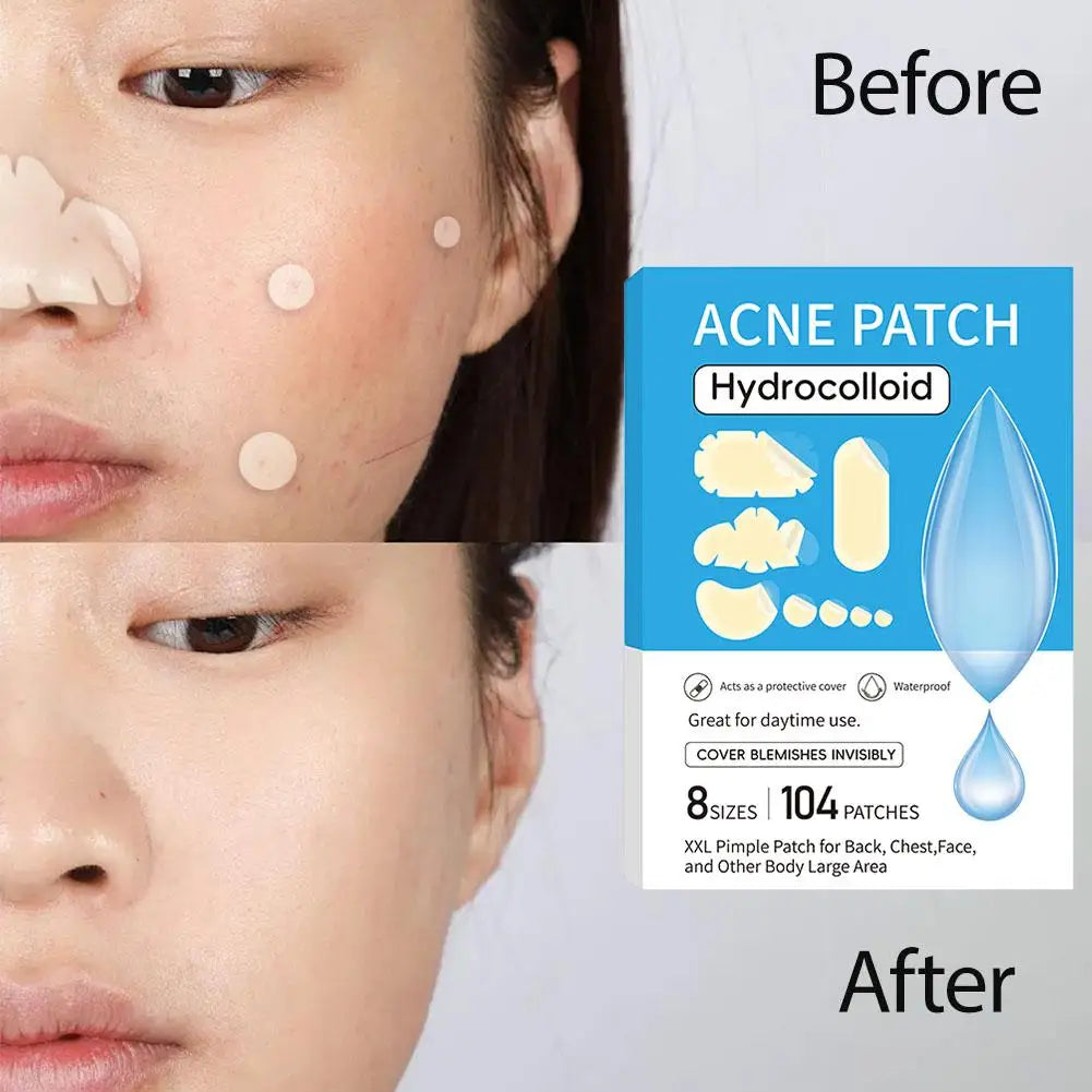 Hydrocolloid Acne Patches – Invisible Spot Treatment Acne Spot Patch Oasis Select
