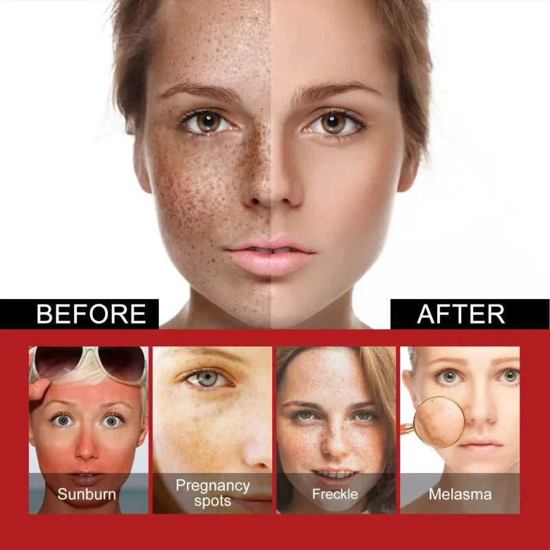 Powerful Spot-Removing Whiten Cream Brighten Skin Fast Eliminates Melanin Pigmentation Melasma Dark Spots Korean Face Skin Care Oasis Select