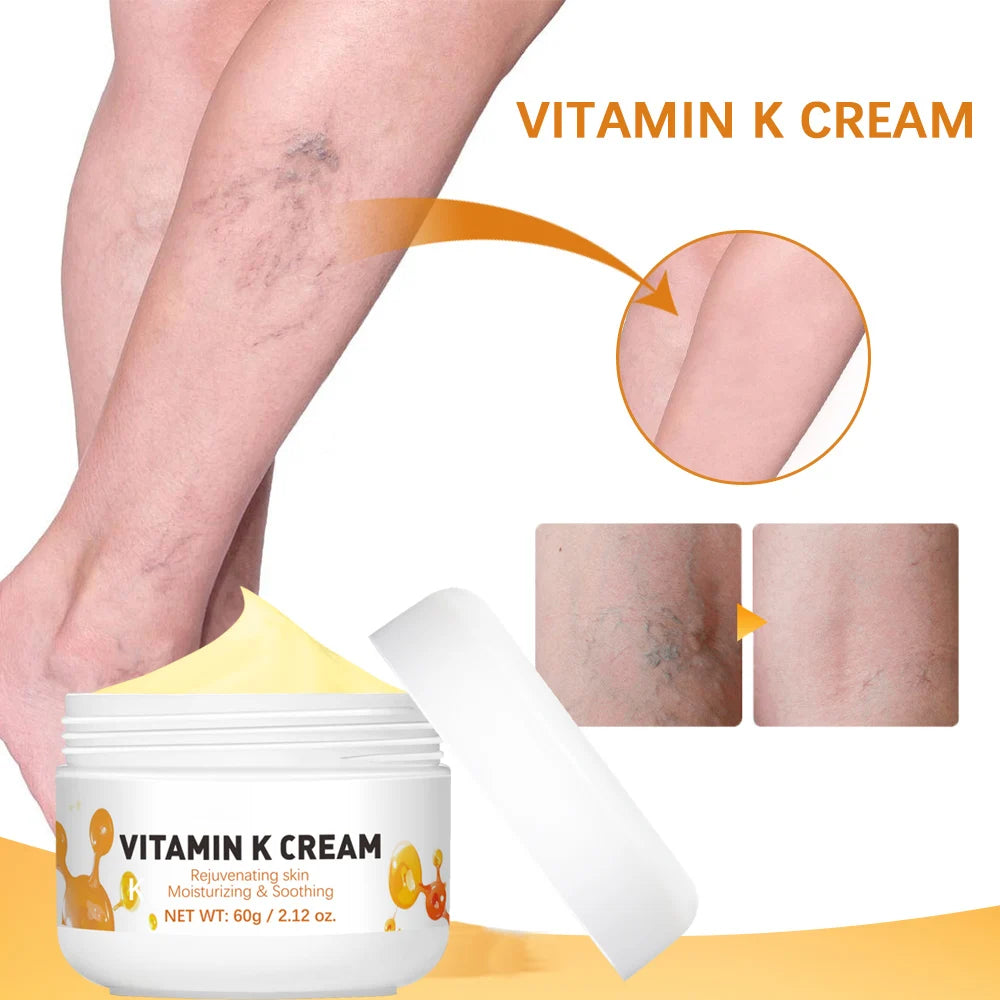 Vitamin K Cream Anti-aging And Wrinkle Removal Varicose Vein Relief Cream Massage Care Relieve Leg Soreness Swelling Ointment Oasis Select