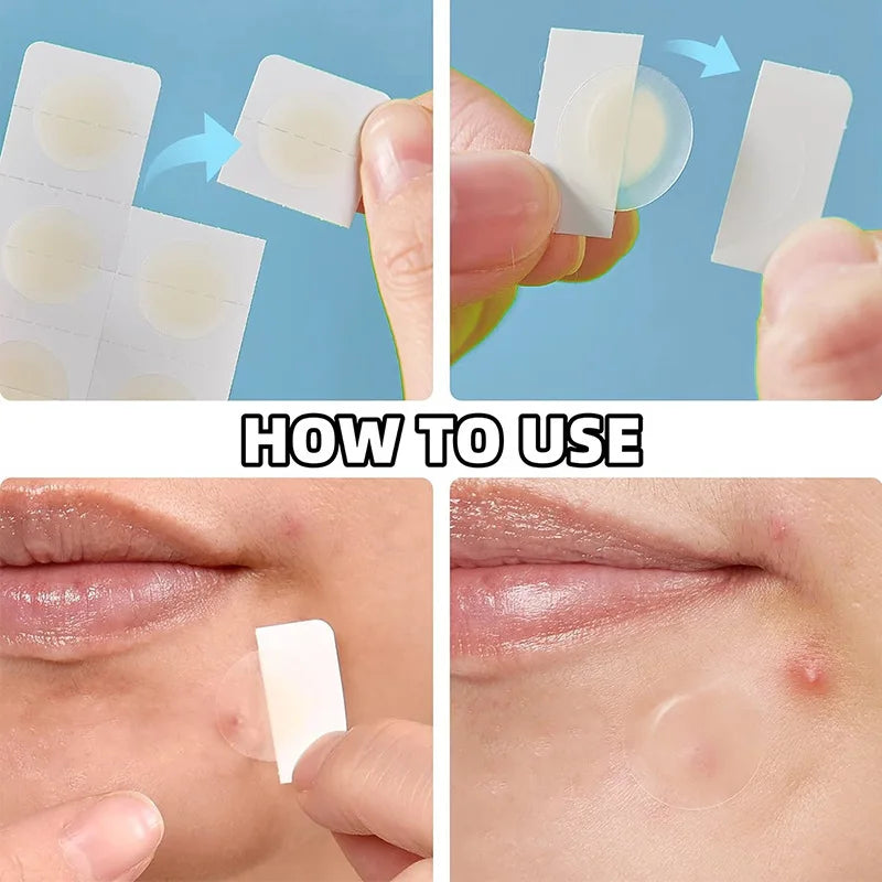 Hydrogel Acne Patches – Invisible, Waterproof 12/48 PCS