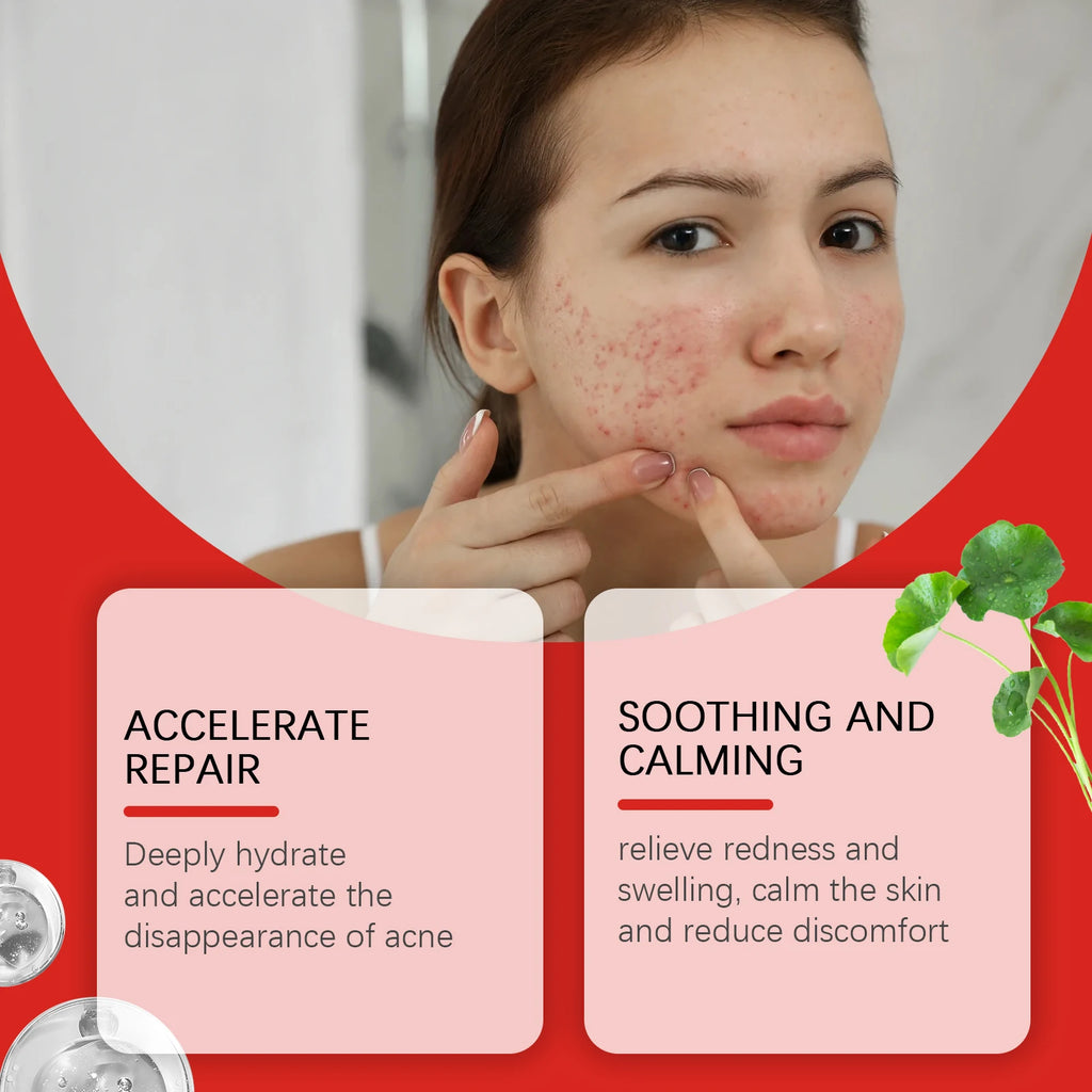 240pc Salicylic Acid Acne Pimple Patches – Fun Shapes Acne Pimple Patches Oasis Select