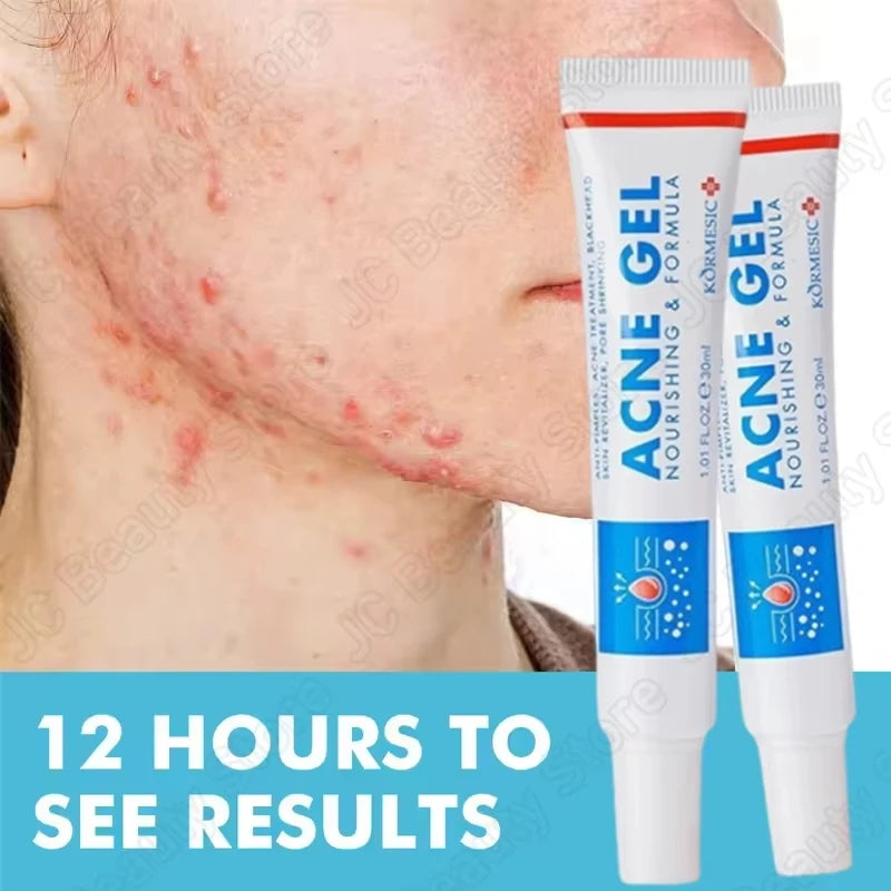 SADOER Salicylic Acid Acne Cream – Oil Control & Pore Minimizer Acne Face Cream Oasis Select