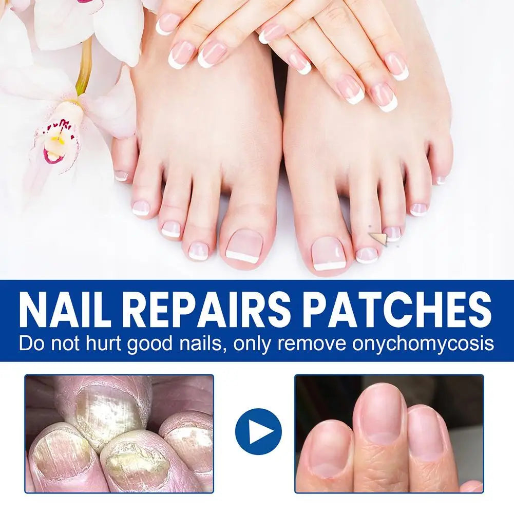 60pcs Toenail Patches Nail Repair Extra Strength Patches For Toenail Fingernail Non-Irritating And Breathable Nail Repair Oasis Select