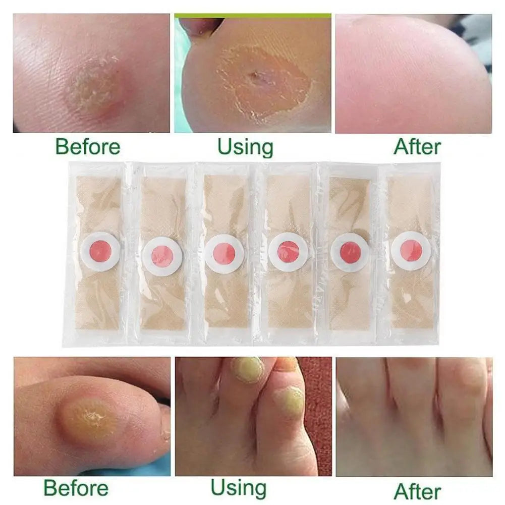 6Pcs Foot Toe Corn And Callus Removers Pads Self-Stick Adhesive Foot Cushion Corn Callus Remover Cushions Foot Care Patches Oasis Select