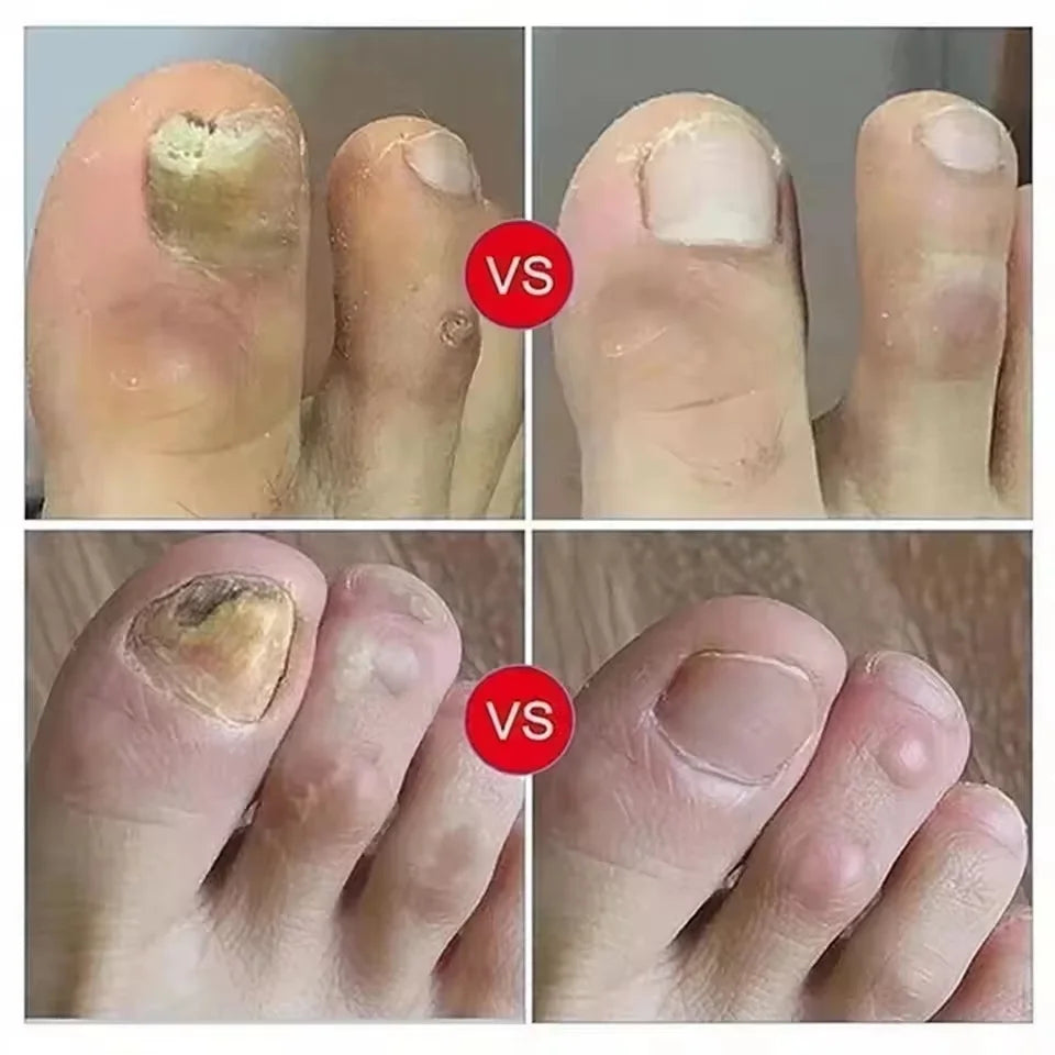 Nail Repair Serum – Foot & Toe Nail Restoration Oil Nail Repair Serum Oasis Select