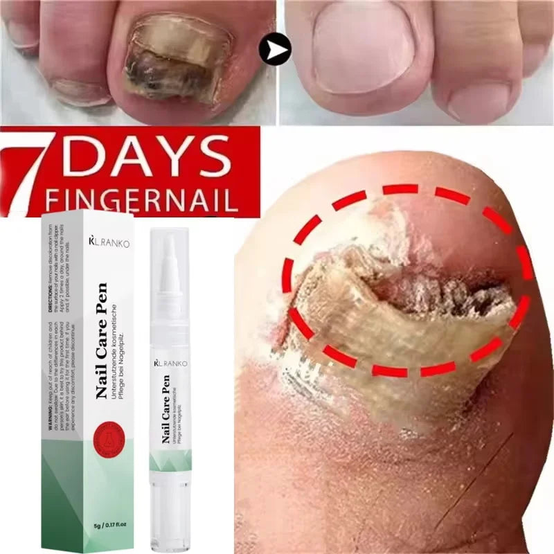 Nail Repair Serum – Foot & Toe Nail Restoration Oil Nail Repair Serum Oasis Select 1pc