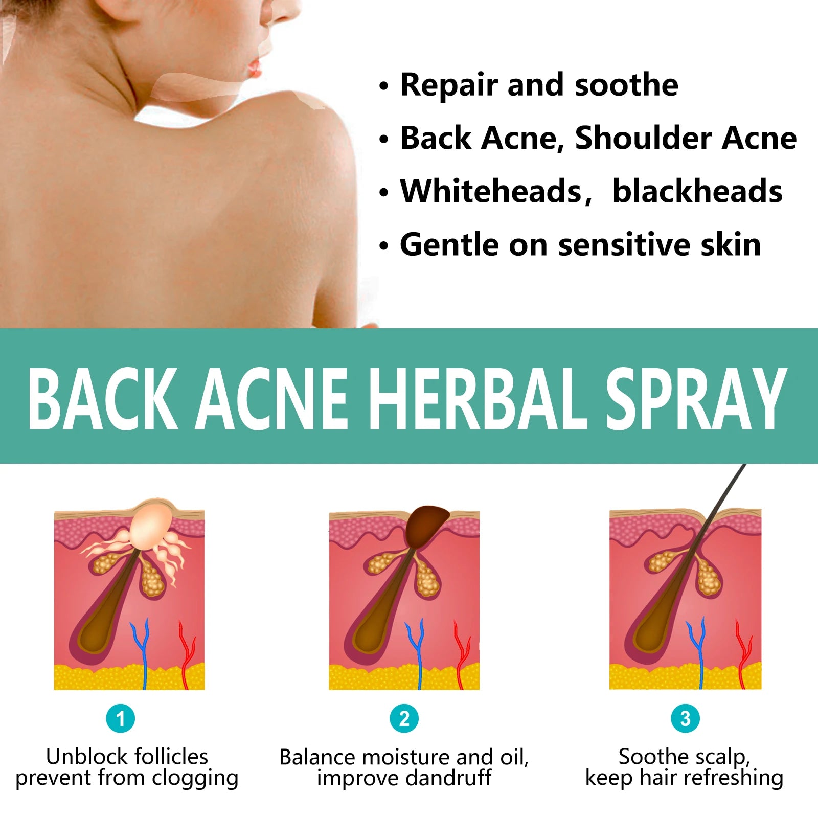 Herbal Acne Remover Spray Back Shoulder Pimple Treatment Blackhead Anti Mites Oil Control Repair Smooth Skin Care Beauty Health Oasis Select