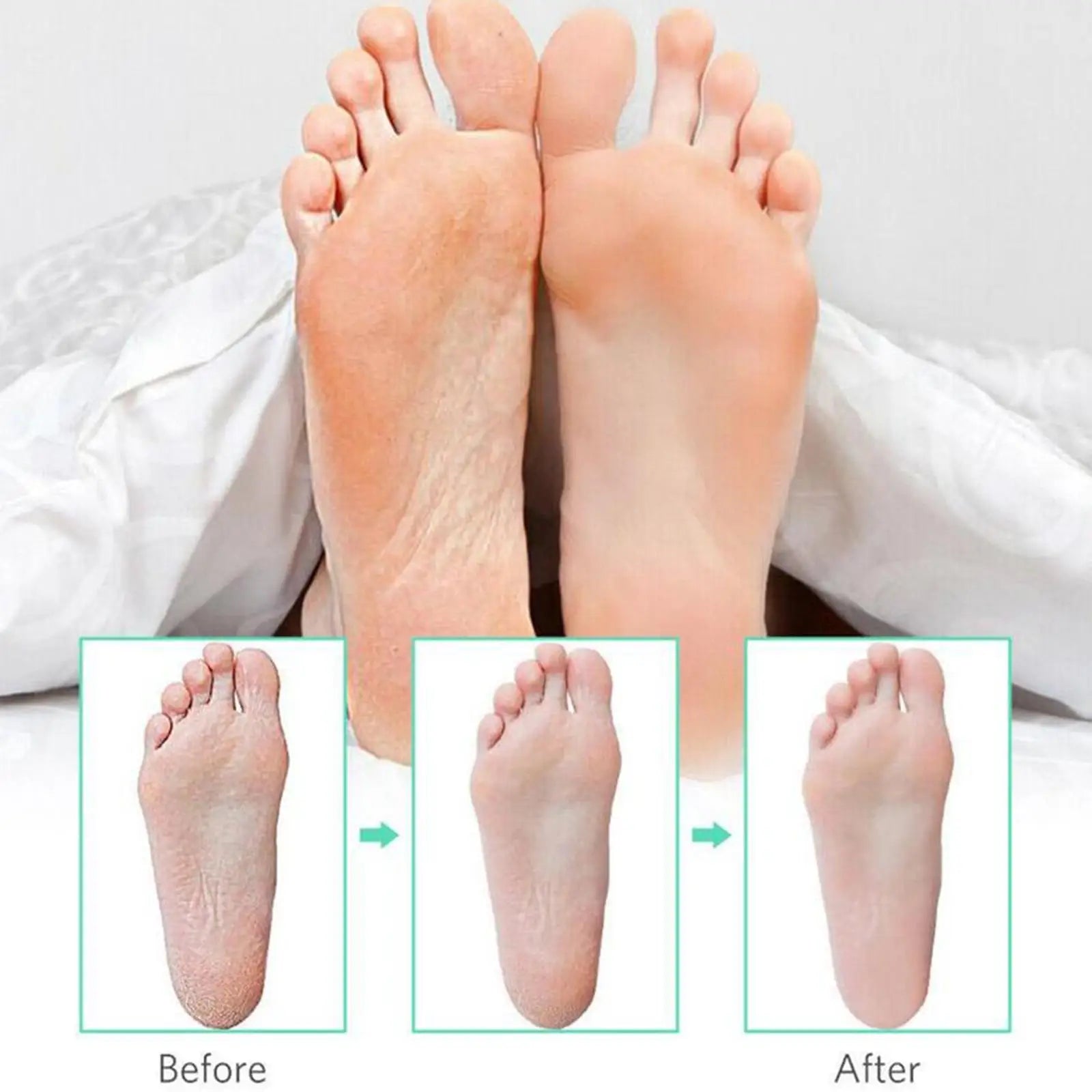 100x Callus Shaver Replacement Blades – Stainless Steel Pedicure Pedicure Replacement Blades Oasis Select