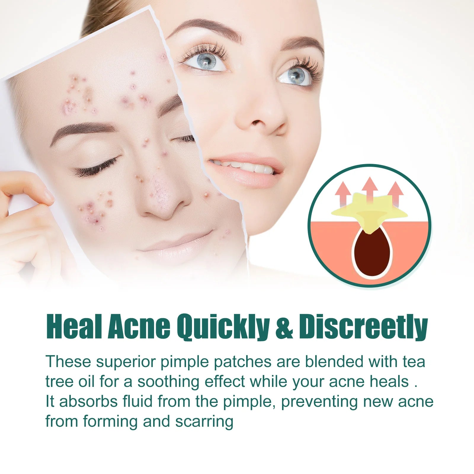 Star-Shaped Acne Pimple Patches – Soothing Blemish Treatment