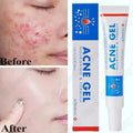 SADOER Salicylic Acid Acne Cream – Oil Control & Pore Minimizer Acne Face Cream Oasis Select 1pc