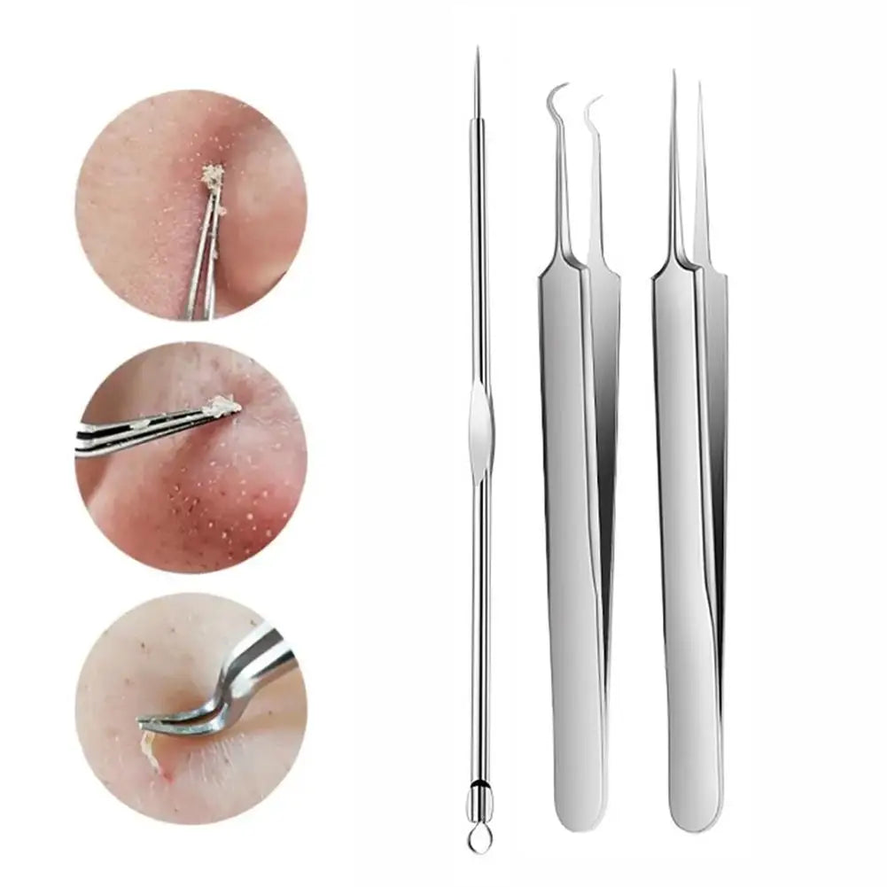 3-Piece Acne Needle & Blackhead Extractor Kit – Stainless Steel Acne Extractor Kit Oasis Select